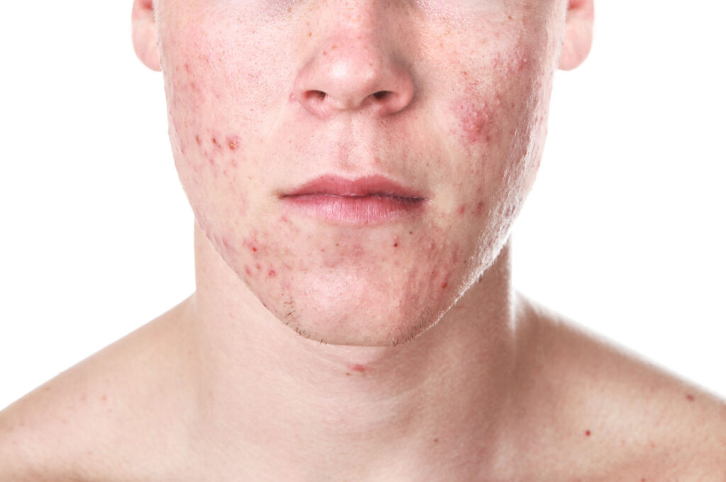 Teenager with Acne - Welcome to Vanguard Dermatology - Vanguard Dermatology | Dermatology
