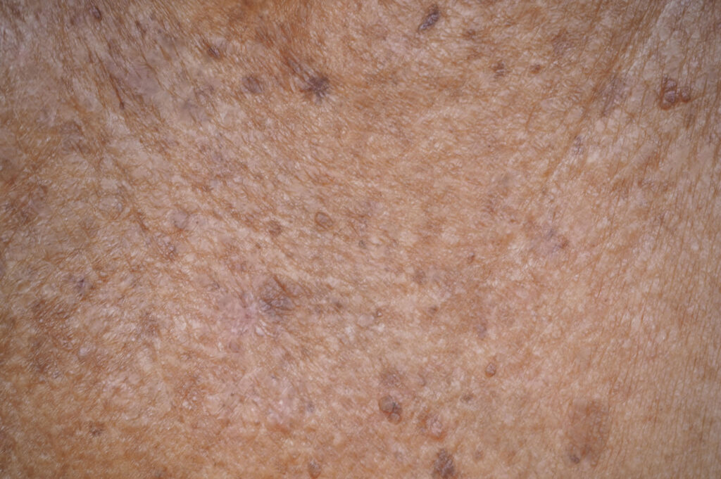 actinic keratosis or melanoma and seborrheic keratosis on collar - Welcome to Vanguard Dermatology - Vanguard Dermatology | Dermatology