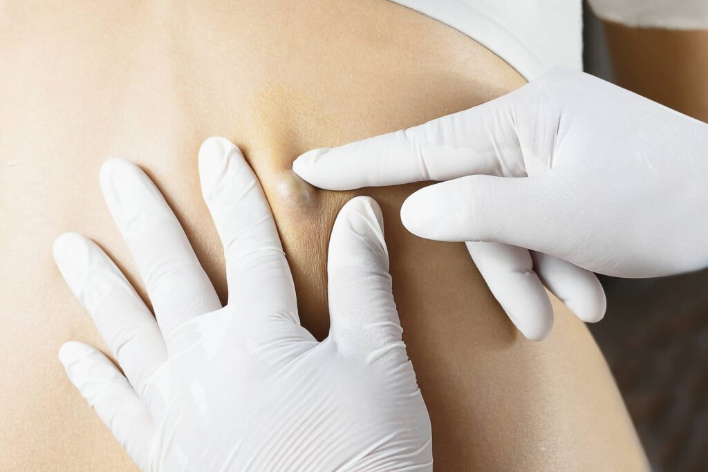 Cyst_final-min - Welcome to Vanguard Dermatology - Vanguard Dermatology | Dermatology