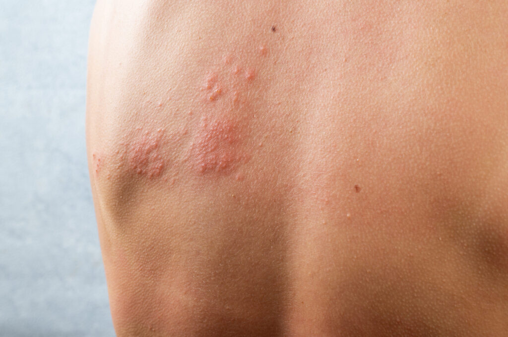 chickenpox rash Shingles varicella-zoster virus skin rash and blisters on body Skin infected Herpes zoster virus Herpes Virus on body urticaria rash atopic dermatitis - Welcome to Vanguard Dermatology - Vanguard Dermatology | Dermatology