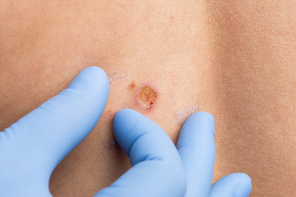 Electrodessication and Curettage_final-min - Welcome to Vanguard Dermatology - Vanguard Dermatology | Dermatology